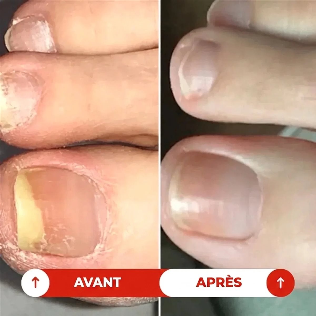 Stylo Podéa Anti-Mycose 4